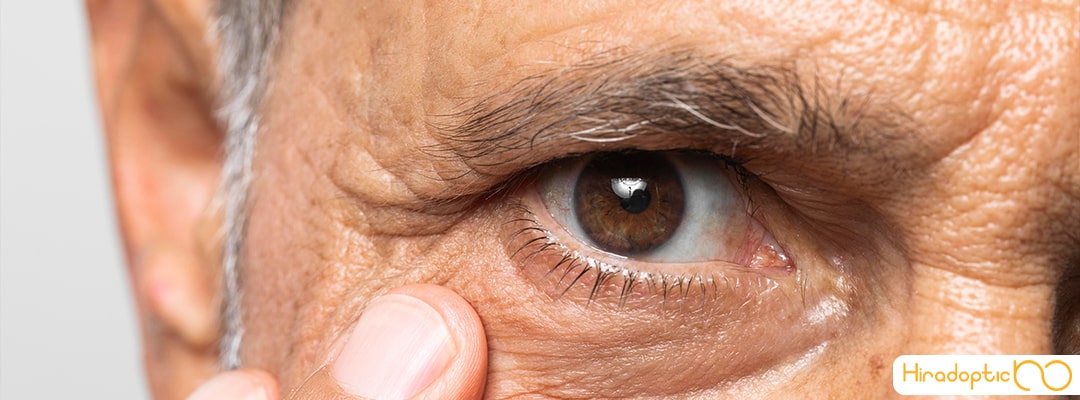 راه های درمان پیر چشمی
