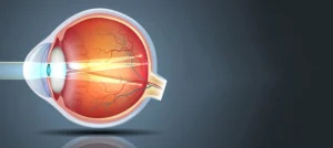 علائم، نشانه ها و درمان آستیگمات چشم چیست؟